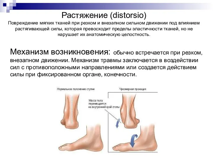 Растяжение (distorsio) Повреждение мягких тканей при резком и внезапном сильном движении