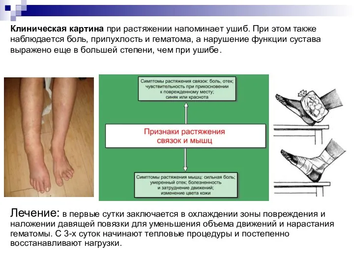 Клиническая картина при растяжении напоминает ушиб. При этом также наблюдается боль,