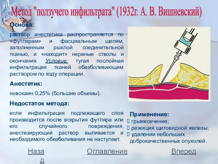 Метод "ползучего инфильтрата" (1932г. А. В. Вишневский) Основа: раствор анестетика распространяется