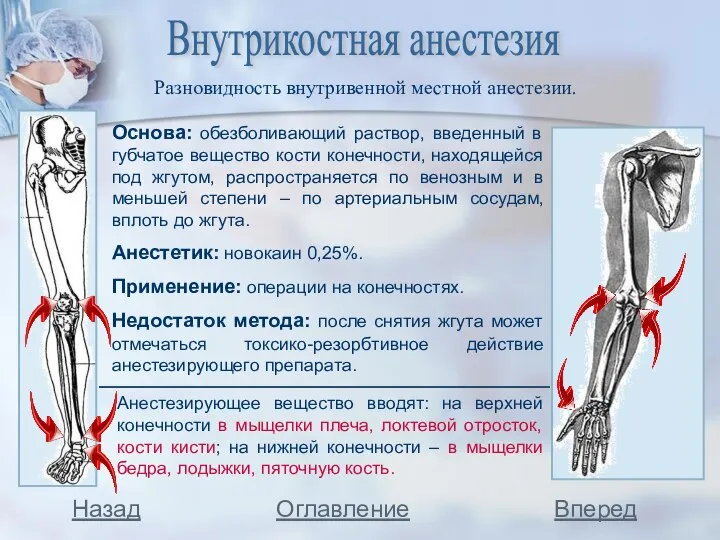 Внутрикостная анестезия Основа: обезболивающий раствор, введенный в губчатое вещество кости конечности,