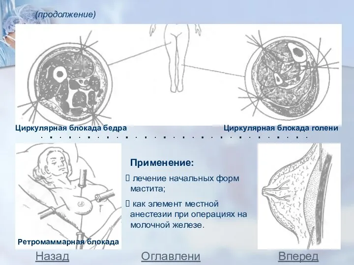 (продолжение) Циркулярная блокада голени Циркулярная блокада бедра Применение: лечение начальных форм