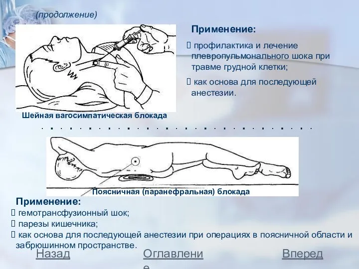 (продолжение) Шейная вагосимпатическая блокада Применение: профилактика и лечение плевропульмонального шока при