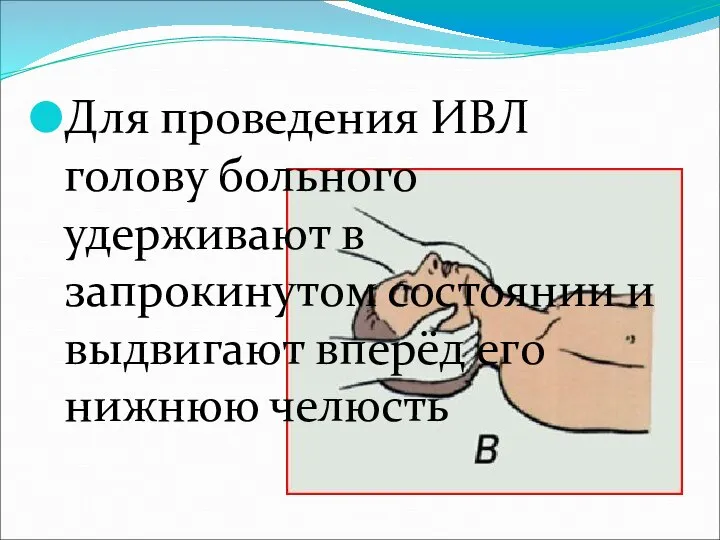 Для проведения ИВЛ голову больного удерживают в запрокинутом состоянии и выдвигают вперёд его нижнюю челюсть