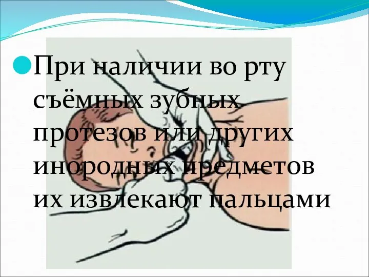 При наличии во рту съёмных зубных протезов или других инородных предметов их извлекают пальцами