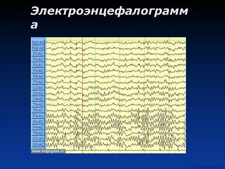 Электроэнцефалограмма