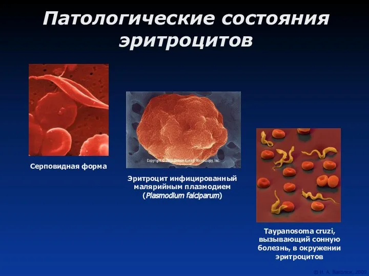 Патологические состояния эритроцитов Taypanosoma cruzi, вызывающий сонную болезнь, в окружении эритроцитов