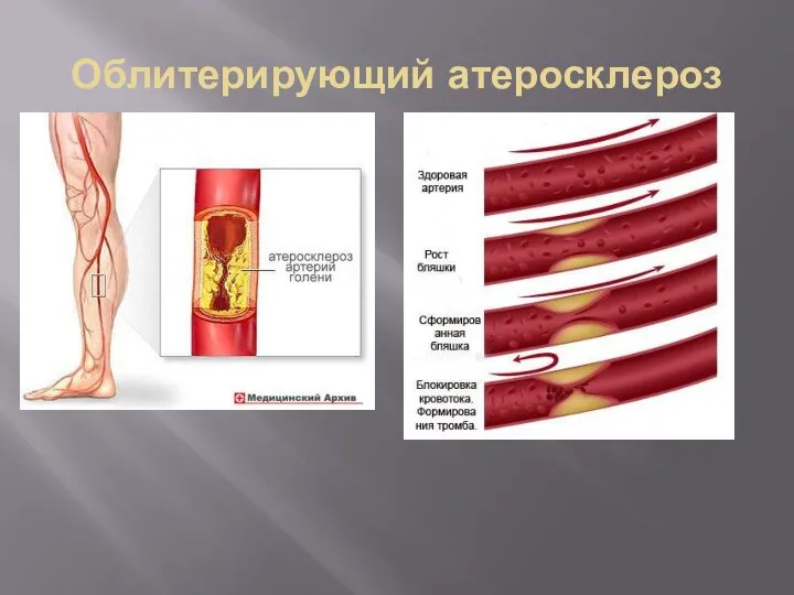 Облитерирующий атеросклероз