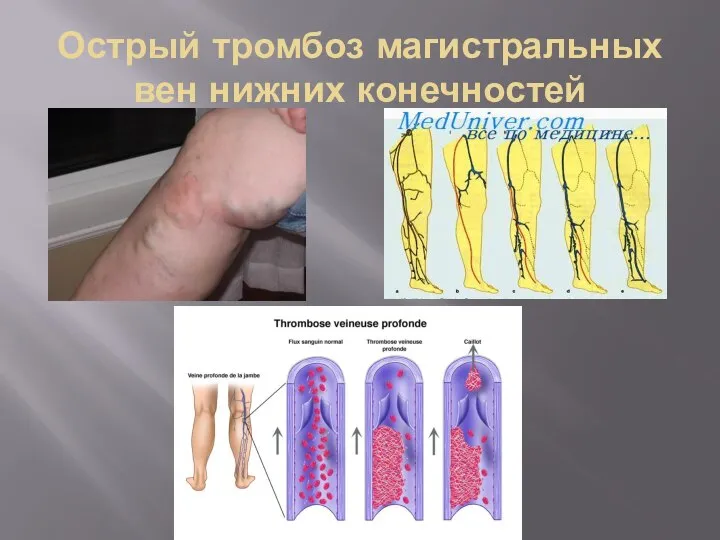 Острый тромбоз магистральных вен нижних конечностей