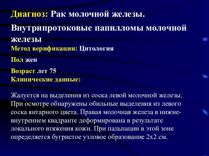 Диагноз: Рак молочной железы. Внутрипротоковые папилломы молочной железы Метод верификации: Цитология