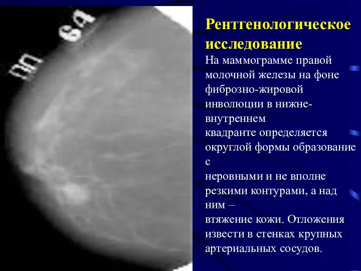 Рентгенологическое исследование На маммограмме правой молочной железы на фоне фиброзно-жировой инволюции