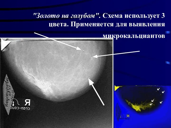 "Золото на голубом". Схема использует 3 цвета. Применяется для выявления микрокальциантов