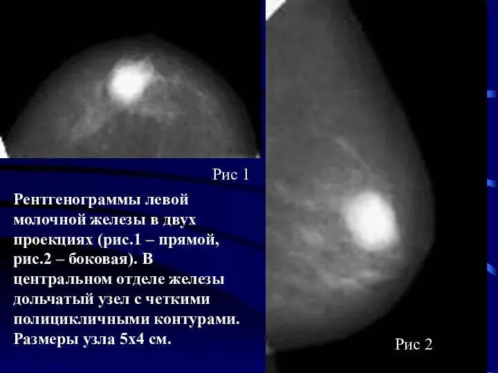 Рентгенограммы левой молочной железы в двух проекциях (рис.1 – прямой, рис.2