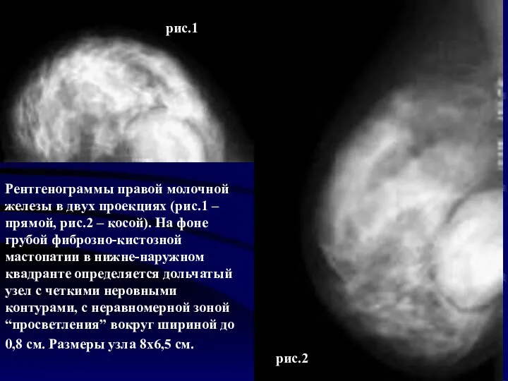 Рентгенограммы правой молочной железы в двух проекциях (рис.1 – прямой, рис.2