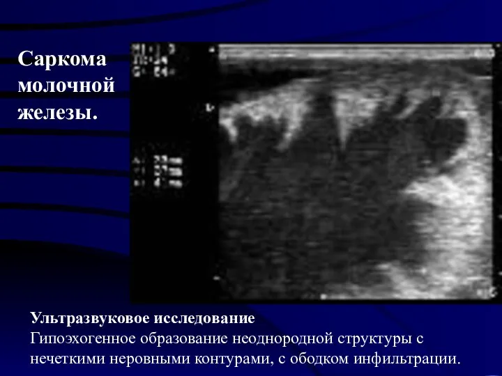 Ультразвуковое исследование Гипоэхогенное образование неоднородной структуры с нечеткими неровными контурами, с ободком инфильтрации. Саркома молочной железы.