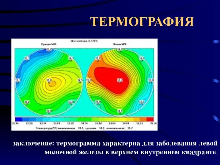 ТЕРМОГРАФИЯ заключение: термограмма характерна для заболевания левой молочной железы в верхнем внутреннем квадранте.