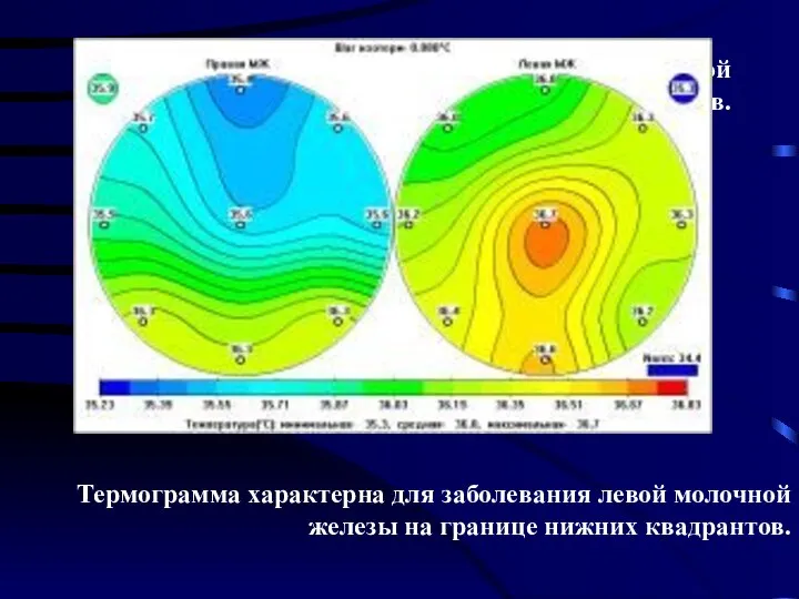 Термограмма характерна для заболевания левой молочной железы на границе нижних квадрантов.