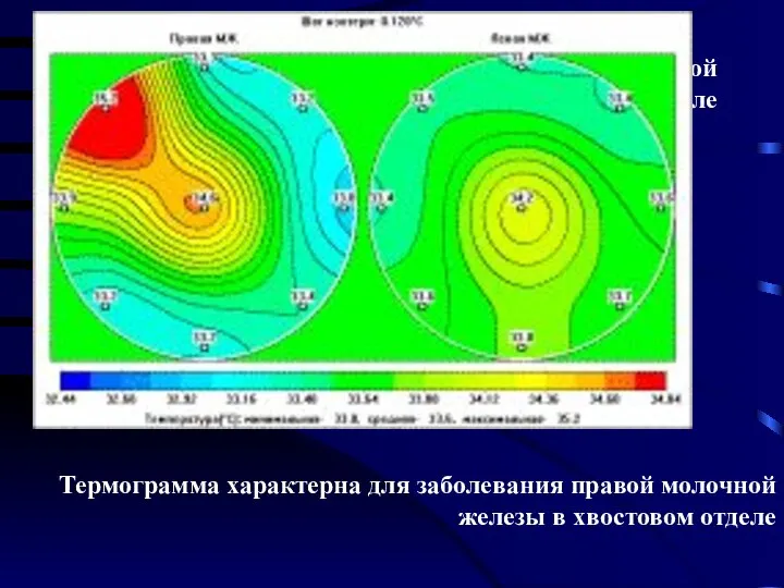 Термограмма характерна для заболевания правой молочной железы в хвостовом отделе Термограмма