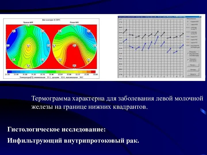 Термограмма характерна для заболевания левой молочной железы на границе нижних квадрантов.