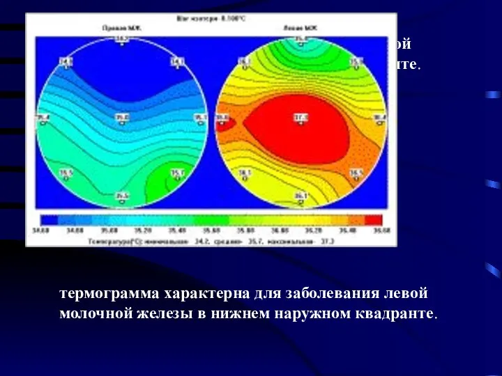 термограмма характерна для заболевания левой молочной железы в нижнем наружном квадранте.