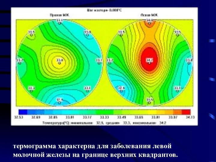 термограмма характерна для заболевания левой молочной железы на границе верхних квадрантов.