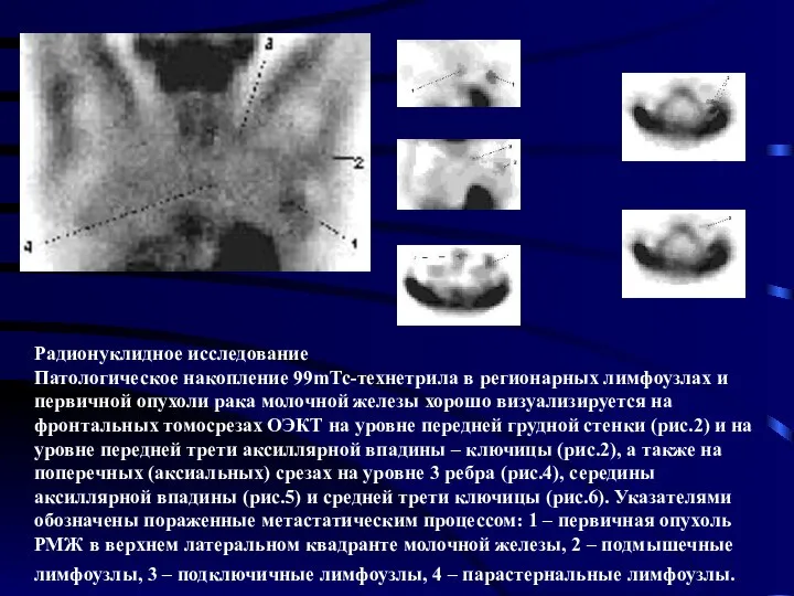 Радионуклидное исследование Патологическое накопление 99mTc-технетрила в регионарных лимфоузлах и первичной опухоли