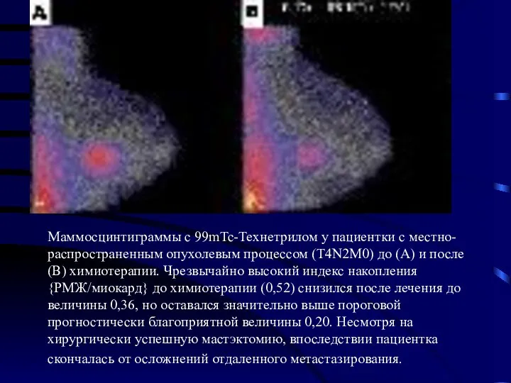 Маммосцинтиграммы с 99mTc-Технетрилом у пациентки с местно-распространенным опухолевым процессом (T4N2M0) до