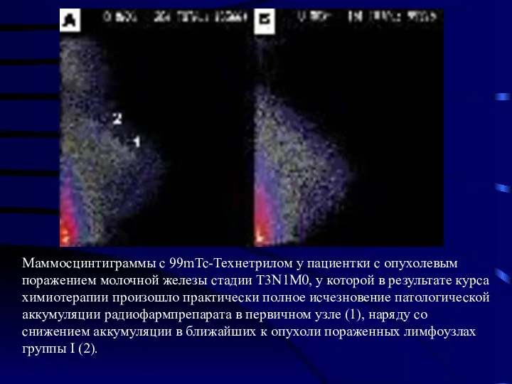 Маммосцинтиграммы с 99mTc-Технетрилом у пациентки с опухолевым поражением молочной железы стадии