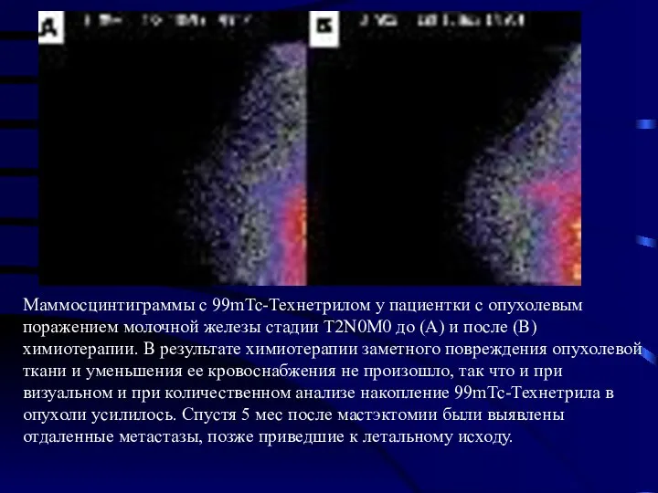 Маммосцинтиграммы с 99mTc-Технетрилом у пациентки с опухолевым поражением молочной железы стадии