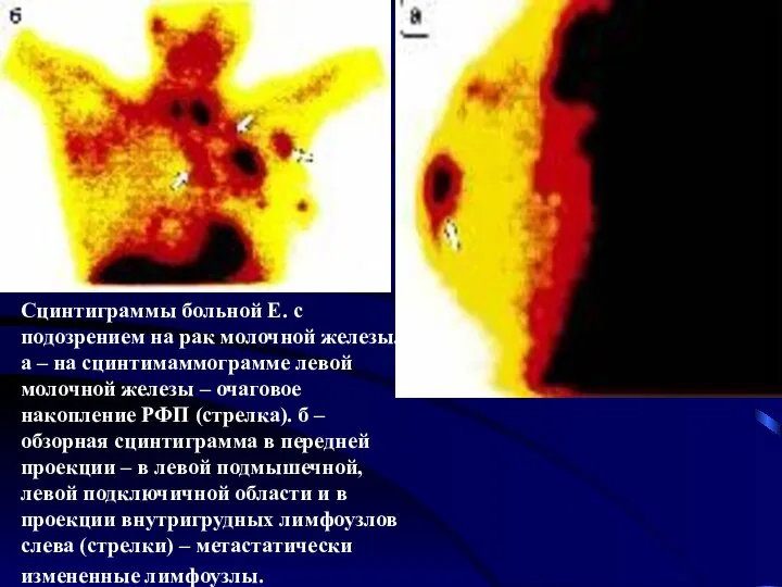 Сцинтиграммы больной Е. с подозрением на рак молочной железы. а –