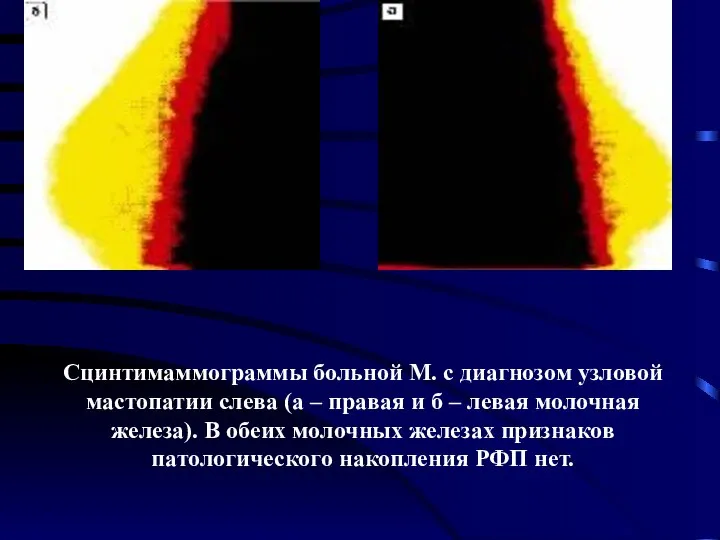 Сцинтимаммограммы больной М. с диагнозом узловой мастопатии слева (а – правая