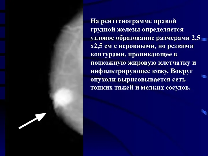 На рентгенограмме правой грудной железы определяется узловое образование размерами 2,5х2,5 см