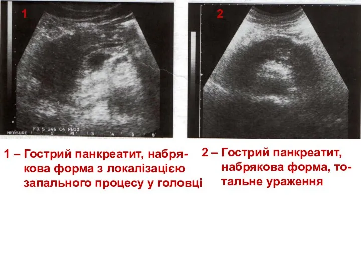 1 2 1 – Гострий панкреатит, набря- кова форма з локалізацією