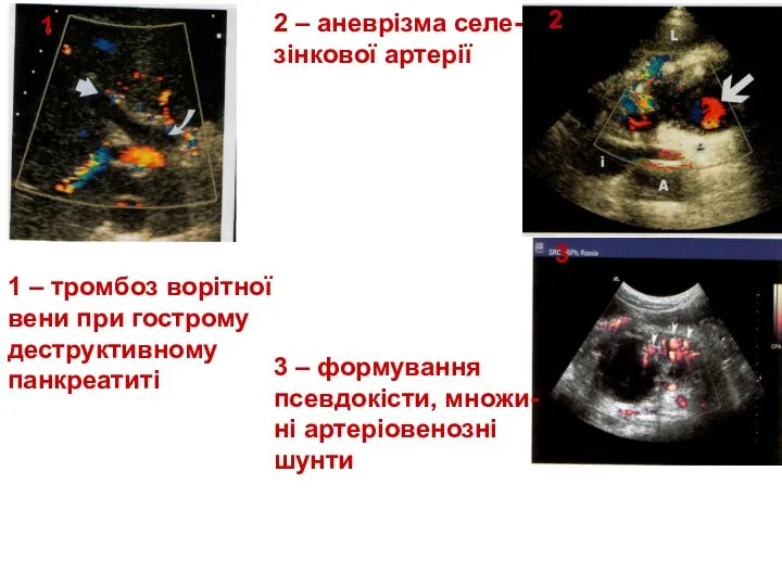 1 2 3 2 – аневрізма селе- зінкової артерії 3 –