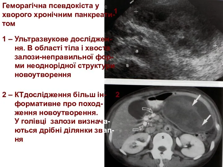 1 2 Геморагічна псевдокіста у хворого хронічним панкреати- том 1 –