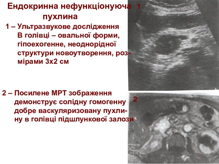 1 2 Ендокринна нефункціонуюча пухлина 1 – Ультразвукове дослідження В голівці