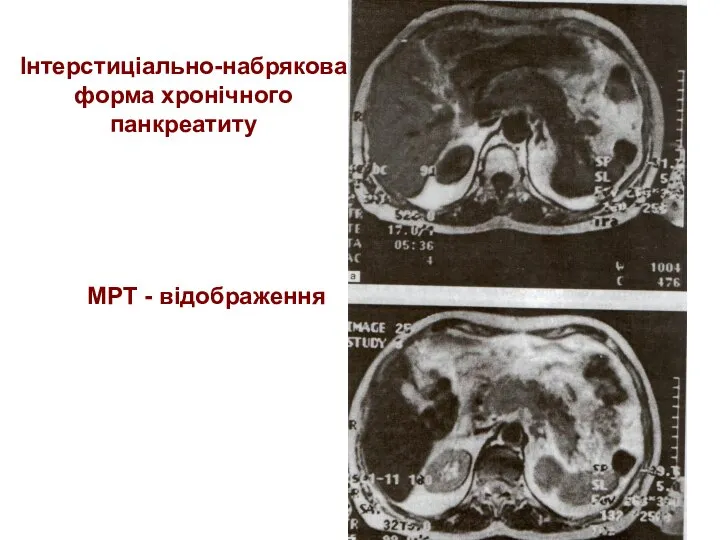 Інтерстиціально-набрякова форма хронічного панкреатиту МРТ - відображення