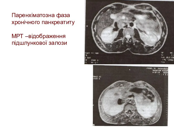 Паренхіматозна фаза хронічного панкреатиту МРТ –відображення підшлункової залози