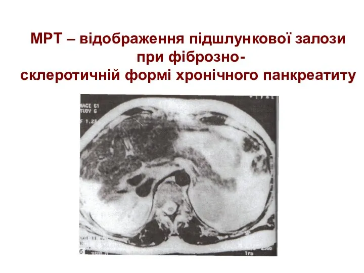 МРТ – відображення підшлункової залози при фіброзно- склеротичній формі хронічного панкреатиту