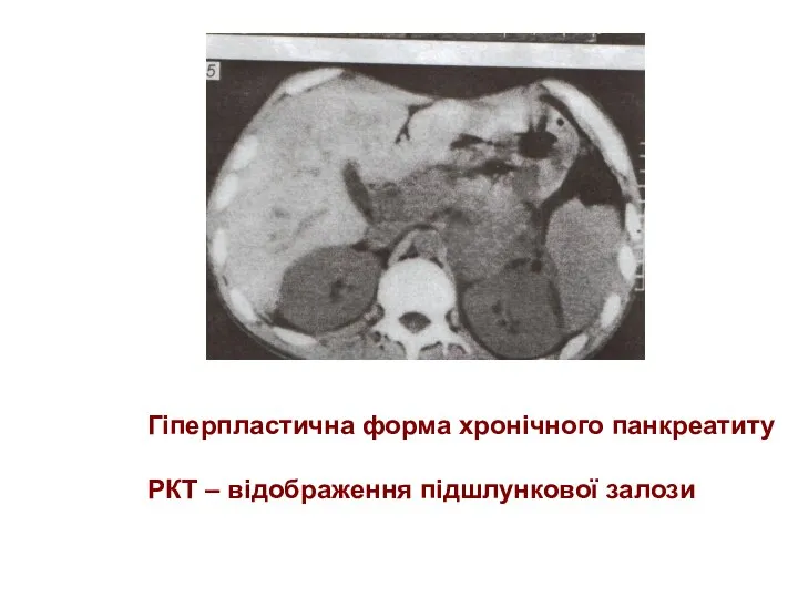Гіперпластична форма хронічного панкреатиту РКТ – відображення підшлункової залози
