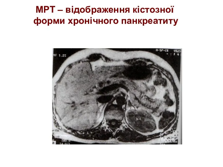 МРТ – відображення кістозної форми хронічного панкреатиту