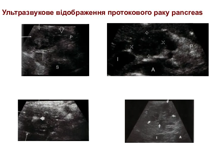 Ультразвукове відображення протокового раку pancreas