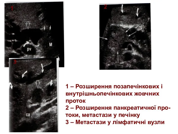 Епн 1 2 3 1 – Розширення позапечінкових і внутрішньопечінкових жовчних