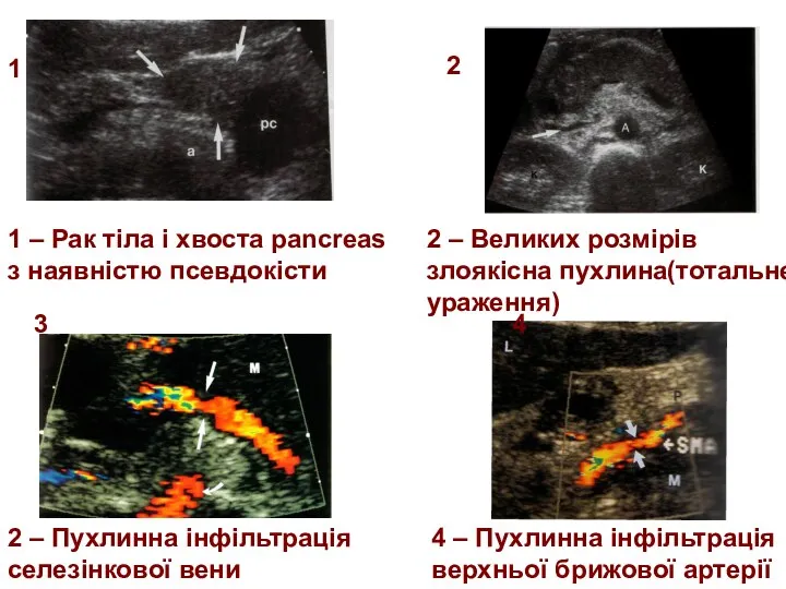 1 2 3 4 1 – Рак тіла і хвоста pancreas