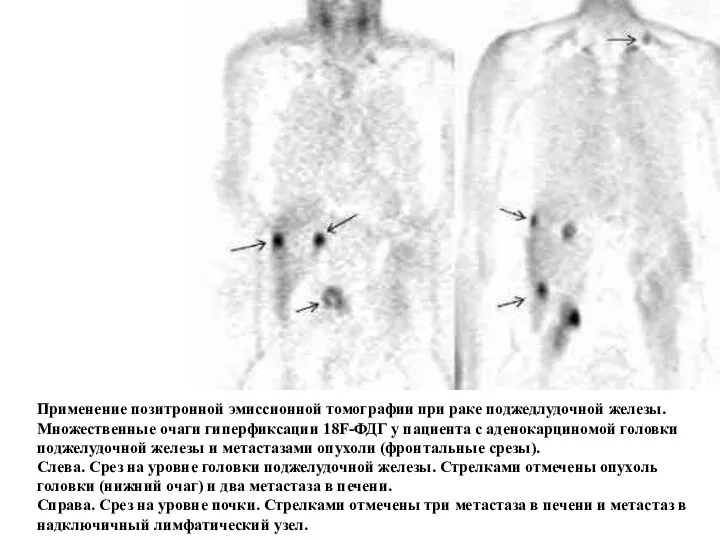 Применение позитронной эмиссионной томографии при раке поджедлудочной железы. Множественные очаги гиперфиксации