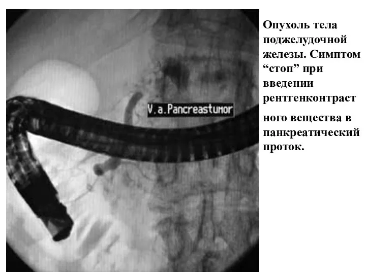 Опухоль тела поджелудочной железы. Симптом “стоп” при введении рентгенконтраст ного вещества в панкреатический проток.