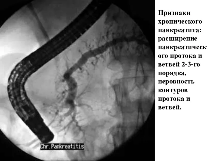 Признаки хронического панкреатита: расширение панкреатического протока и ветвей 2-3-го порядка, неровность контуров протока и ветвей.