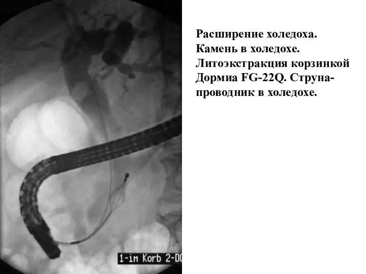 Расширение холедоха. Камень в холедохе. Литоэкстракция корзинкой Дормиа FG-22Q. Струна-проводник в холедохе.