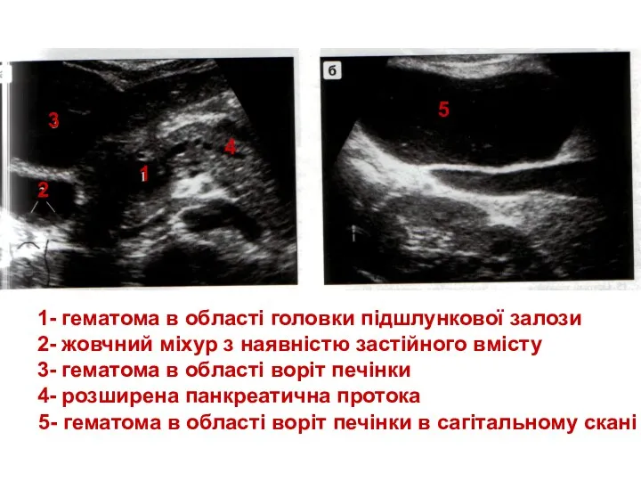 1- гематома в області головки підшлункової залози 2- жовчний міхур з
