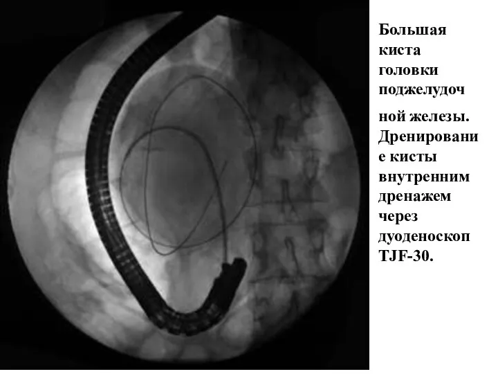 Большая киста головки поджелудоч ной железы. Дренирование кисты внутренним дренажем через дуоденоскоп ТJF-30.