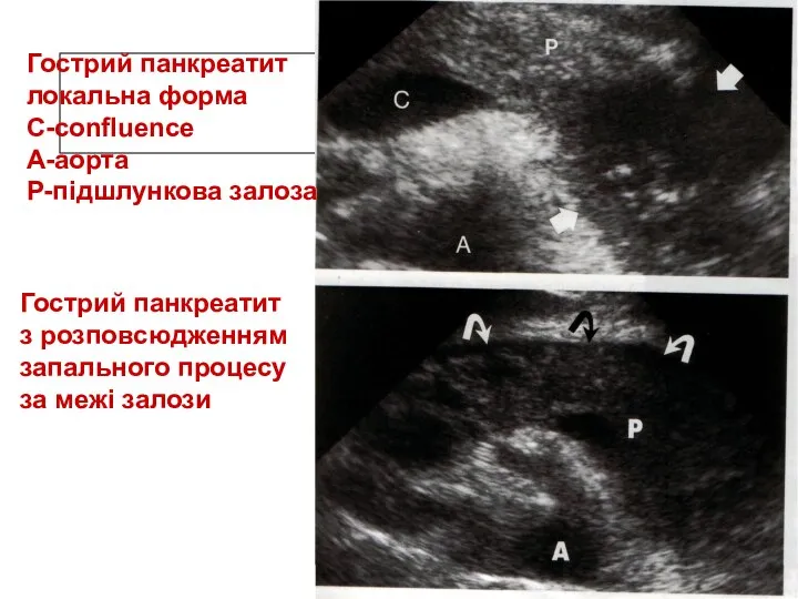 Гострий панкреатит локальна форма С-confluence A-аорта Р-підшлункова залоза Гострий панкреатит з